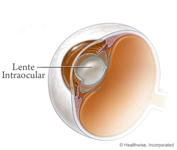 cataratas y lente intraocular