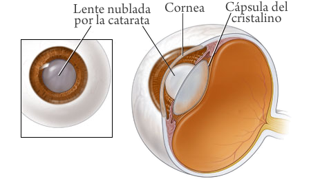 cataratas de ojos