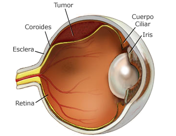 anatomia de ojo con tumor