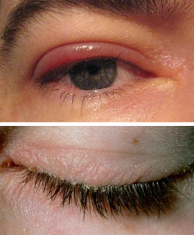 Blefaritis, tratamiento y remedios caseros - Operación de Ojos